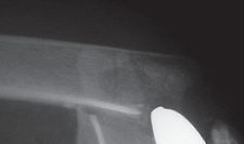 Illustration 3 for Mastering Periprosthetic Femoral Fractures Above Knee Arthroplasty