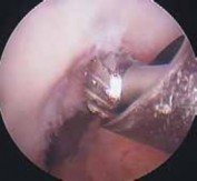 Illustration 39 for Optimizing Single-Bundle Anterior Cruciate Ligament Repair