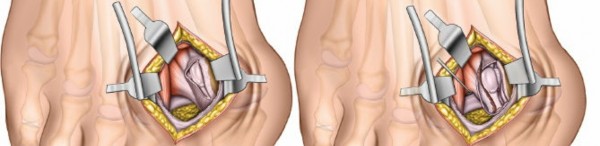 Illustration 212 for Optimized Approaches to the Dorsum of the Foot & Ankle
