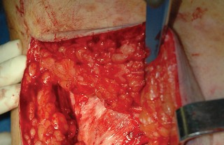 Illustration 4 for Femoral Stem Revision: Posterior Approach for Better Outcomes
