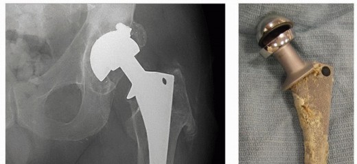 Illustration 4 for Mastering Revision THA: Strategies for Adverse Local Tissue Challenges
