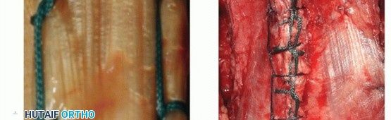 Illustration 36 for Distal Humeral Fractures: When Is Elbow Replacement the Best Option?