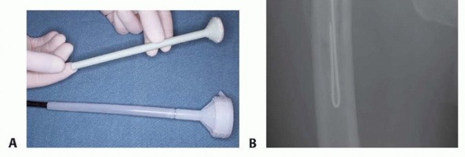 Illustration 14 for Resection Arthroplasty & Spacers: Optimizing Time of Reimplantation