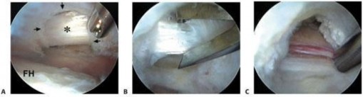 Illustration 113 for Stop the Snap: Hip Preservation for Snapping Iliopsoas Tendon