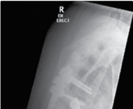 Illustration 8 for Mastering Thoracolumbar Surgery: Full Operative Planning