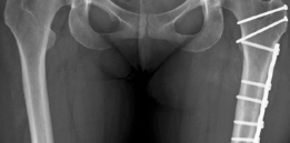 Illustration 9 for Beyond Arthroscopy: Surgical Hip Dislocation for Complex Instability