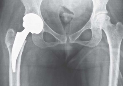 Illustration 36 for Considering METHA Short Stem? Discover Bone-Preserving THA