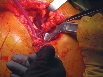 Illustration 26 for Unlock better THA: The technique of short stem for less invasiveness