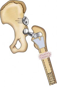 Illustration 137 for Successful Total Hip Replacement in Developmental Dysplasia