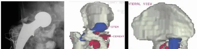 صورة توضيحية لـ الأجهزة ثلاثية الشفاه المخصصة: حل مبتكر لفقدان عظم الحوض الشديد واستعادة وظيفة مفصل الورك