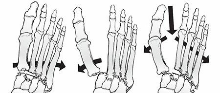 Illustration 20 for Mastering First MTP Joint & Forefoot Fractures: A Comprehensive Guide