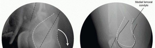 Illustration 3 for Repairing Distal Femur Fractures: Open Reduction & Internal Fixation