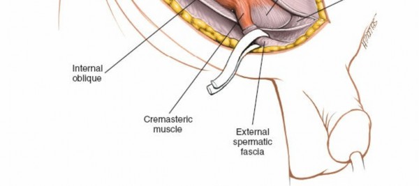 Illustration 63 for Pelvis & Acetabulum Approaches: Unlocking the Posterior Superior Iliac