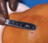 Illustration 5 for Percutaneous Epiphysiodesis: Precisely Closing the Third of the Physis