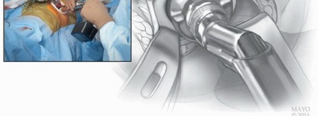 صورة طبية: النهج الأمامي لاستبدال مفصل الورك الكلي: ثورة في جراحة الورك مع الأستاذ الدكتور محمد هطيف في صنعاء