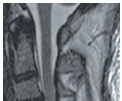 Illustration 4 for Stop Numbness & Instability: Corpectomy and Fusion Guide