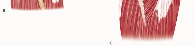 Illustration 39 for Surgical Approaches to Shoulder & Elbow: Pearls and Pitfalls