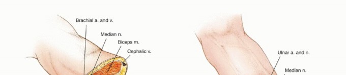 Illustration 21 for Above-Elbow & Below-Elbow Amputations: When & Why They're Needed