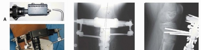 Illustration 8 for Solving Infantile Blount Disease: Surgical Management Strategies