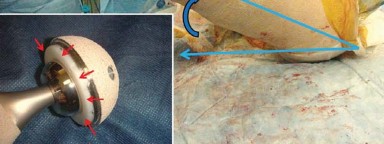 صورة طبية: إتقان توازن الأنسجة الرخوة لمفصل ورك صناعي مثالي: دليل شامل للمرضى مع الأستاذ الدكتور محمد هطيف