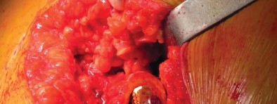 Illustration 34 for Unlock better THA: The technique of short stem for less invasiveness