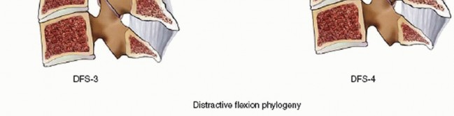 Illustration 30 for Master Techniques for Cervical Fracture Reduction: Type III & More