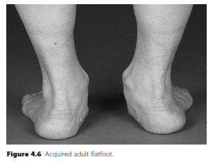 Unraveling Acquired Adult Flatfoot: Key Answers for Orthopedics