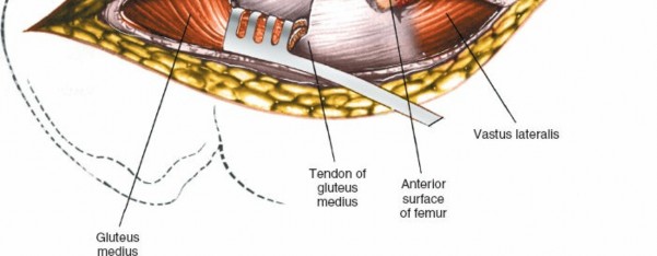 Illustration 117 for Unlocking Every Aspect of the Hip's Surgical Approaches