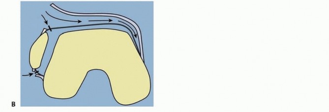 Illustration 43 for Treatment for Congenital Femoral Deficiency: What You Need to Know