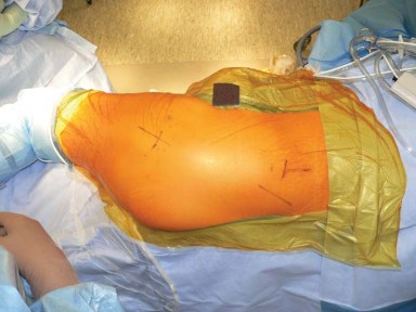 Illustration 11 for Exploring the Ambulatory Surgical Setting for Total Hip Replacement