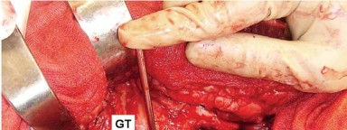 صورة توضيحية لـ إتقان توازن الأنسجة الرخوة لمفصل ورك صناعي مثالي: دليل شامل للمرضى مع الأستاذ الدكتور محمد هطيف