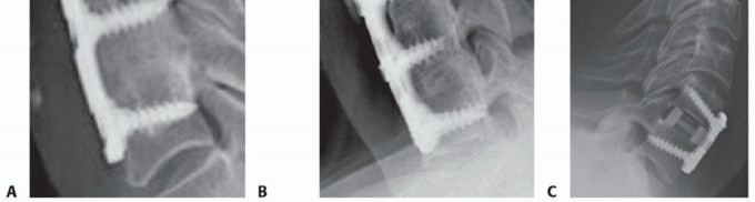 Illustration 24 for How ACDF Clears Your Posterior Disc Space for Lasting Relief