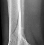 Illustration 3 for Decoding Pilon Fractures: Anterolateral and Medial Fragments Revealed