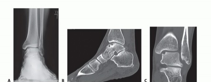 Microfracture for OLTs: Restore a rim of stable, healthy bone & cartilage.