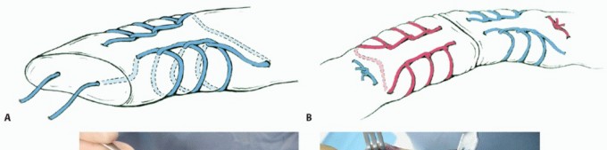 Your Guide to Successful Open Achilles Tendon Repair & Healing