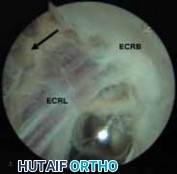 Illustration 7 for Unlock Relief: Arthroscopic Treatment of Epicondylitis Explained
