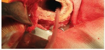 Illustration 28 for Why Polished Tapered Cemented Stems Excel in Hip Replacement