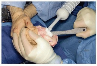 Illustration 16 for Allograft Prosthetic Composite: Mastering Proximal Femur Reconstruction