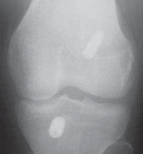 Illustration 93 for Optimizing Single-Bundle Anterior Cruciate Ligament Repair