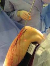 Illustration 24 for Optimal Nailing of the Tibia: Techniques for Challenging Fractures