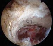 Illustration 24 for Arthroscopic Subscapularis Repair: The lo iky brady Method for Stability