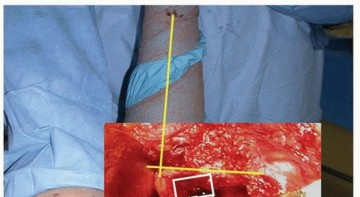 Illustration 5 for Why Double-Tapered Primary Stems Deliver Lasting Stability