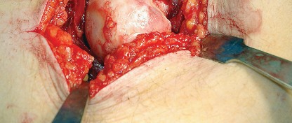 Illustration 32 for Unlock the Figure Posterior Approach to the Hip