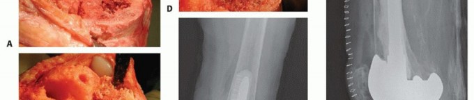 Illustration 4 for Bone Loss Bone Grafting for Challenging Tibial Defects