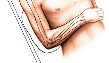 Illustration 72 for Mastering the Approach to the Distal Humerus: Safety & Skills