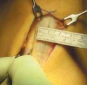 Illustration 9 for Optimizing Single-Bundle Anterior Cruciate Ligament Repair