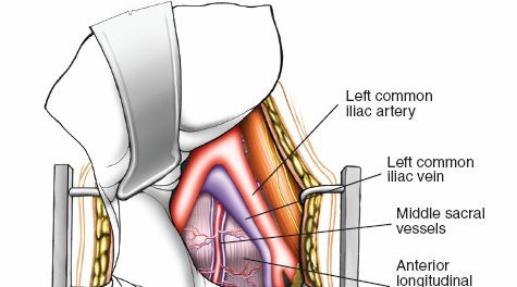 Illustration 90 for Approach to the Lumbar Spine: Mastering Techniques & Anatomy
