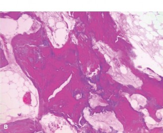 Illustration 2 for Unraveling Oncology Cases: Paget Disease Explained