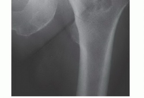 Illustration 10 for Plain Radiograph Showing MBD: Surgical Planning to Prevent Failures