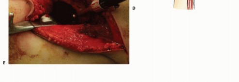 Illustration 34 for Pelvic Metastasis Surgery: A Component of the Utilitarian Approach